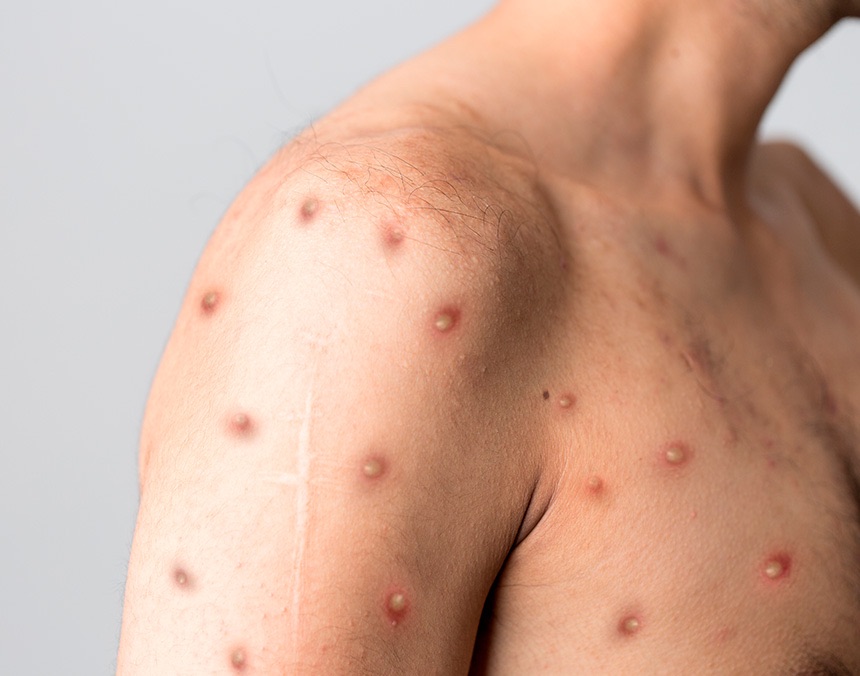 Virus de la viruela símica mpox y lesiones cutáneas asociadas a la enfermedad